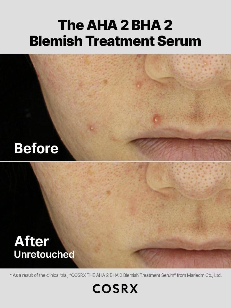 The AHA 2 BHA 2 Blemish Treatment Serum - Image 3